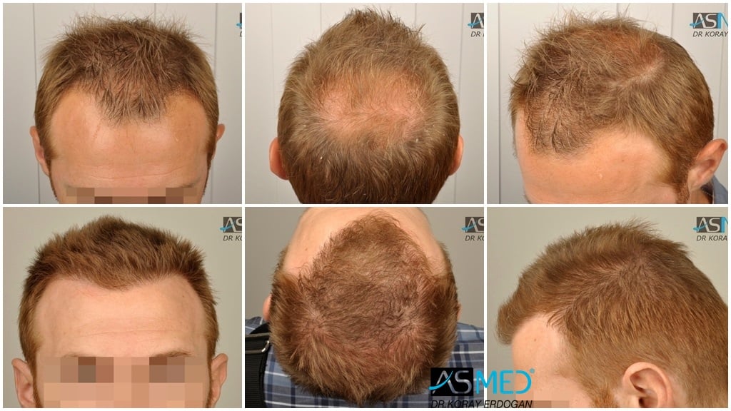 ASMED Hair Transplant Results Gallery Norwood 3 Vertex