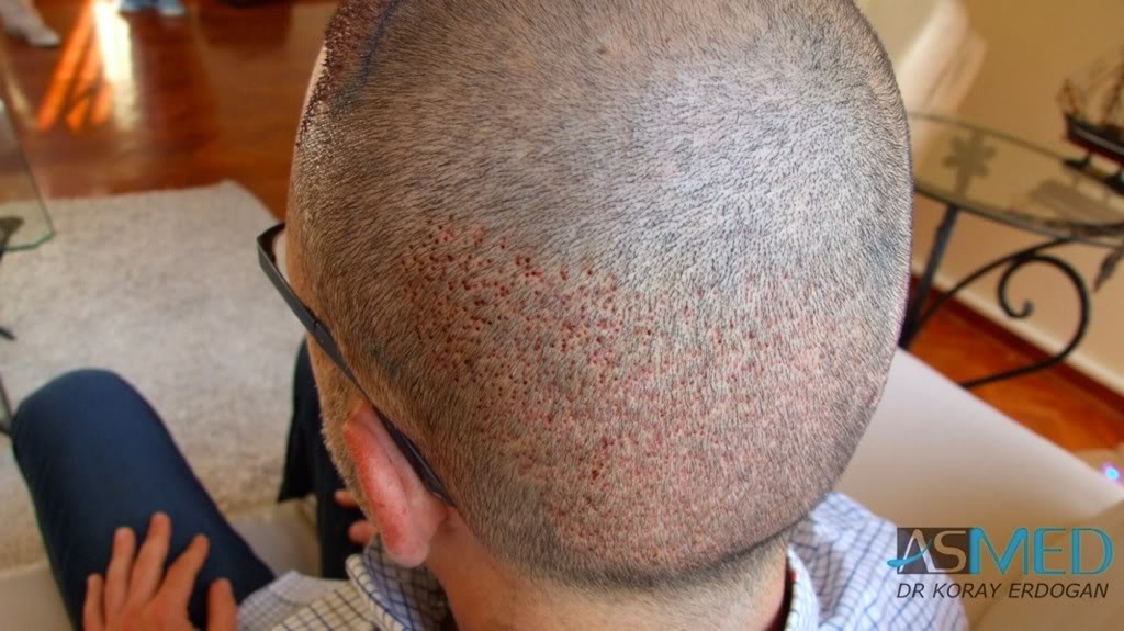 4800 (2600 FUE + 2200 FUE) Grafts Fue | Norwood 3 | Asmed Hair ...