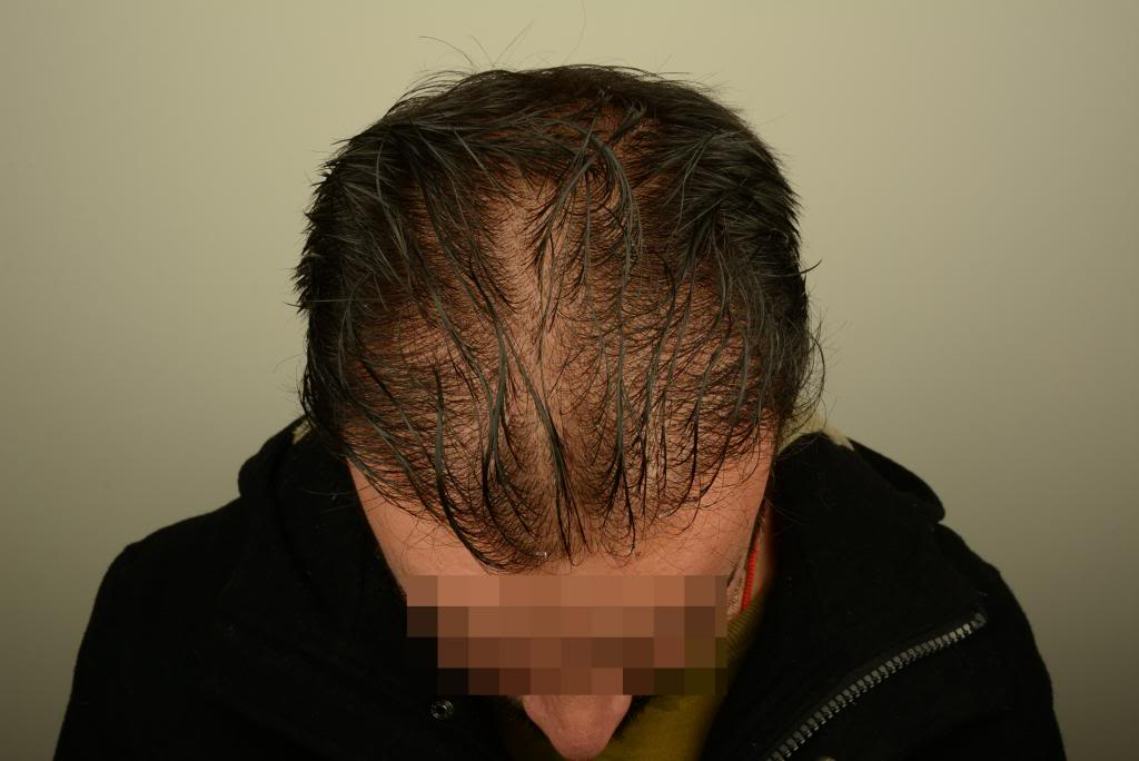 4000 Grafts Fue | Norwood 3 | Asmed Hair Transplant Results