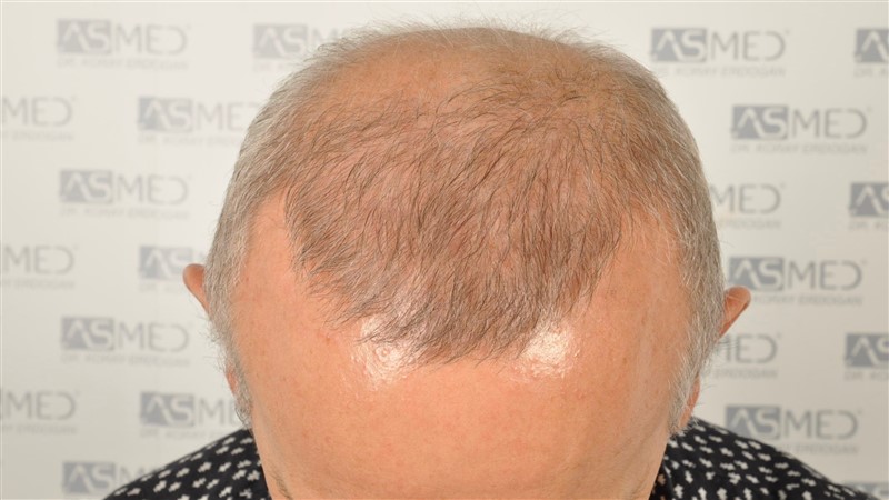 https://www.hairtransplantfue.org/asmed-hair-transplant-result/upload/Norwood5/4005-grafts-FUE/1FUE/2years/_DSC2911.jpg
