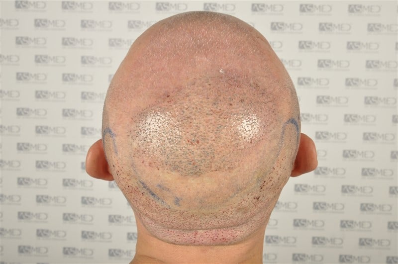 https://www.hairtransplantfue.org/asmed-hair-transplant-result/upload/Norwood5/4005-grafts-FUE/2FUE/operation/_DSC3262.jpg
