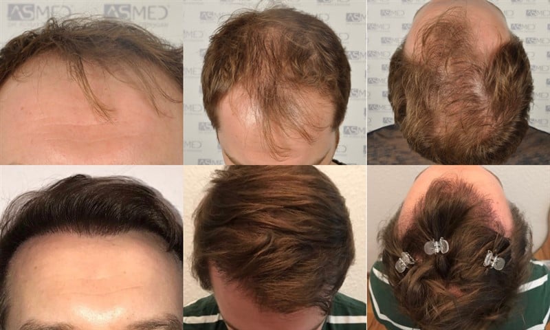 https://www.hairtransplantfue.org/asmed-hair-transplant-result/upload/Norwood5/5021-grafts-fue/collage.jpg