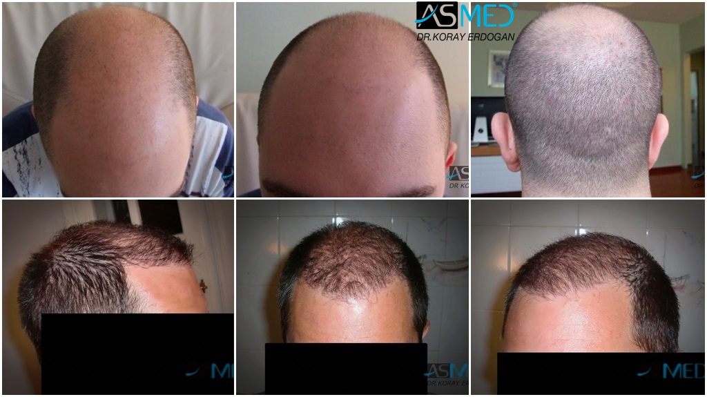 Results Norwood 6 Asmed Hair Transplant